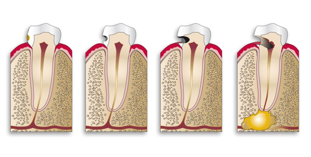 Cavities The Ultimate Guide Quarterpath Dental - Chart Of Tooth Decay From Fast Food