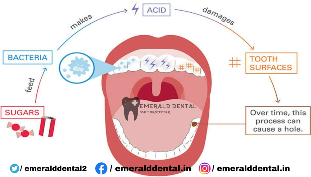 CHILDREN S TEETH IMPACT OF SUGAR EMERALD DENTAL - Chart Of Teeth Isues From Fast Food