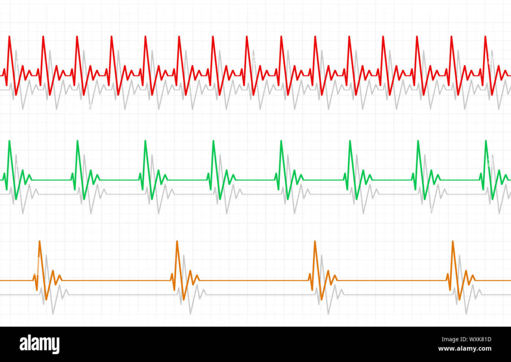 Fast Heart Rate Hi res Stock Photography And Images Alamy - Fast Heart Beat Chart