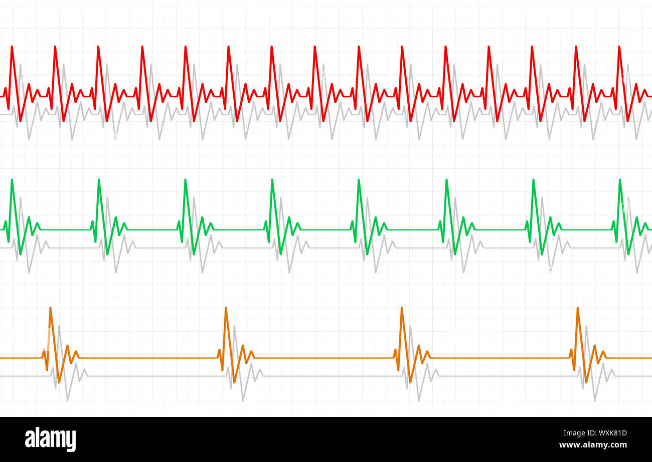 Fast Heart Rate Hi res Stock Photography And Images Alamy - Fast Heart Beat Chart