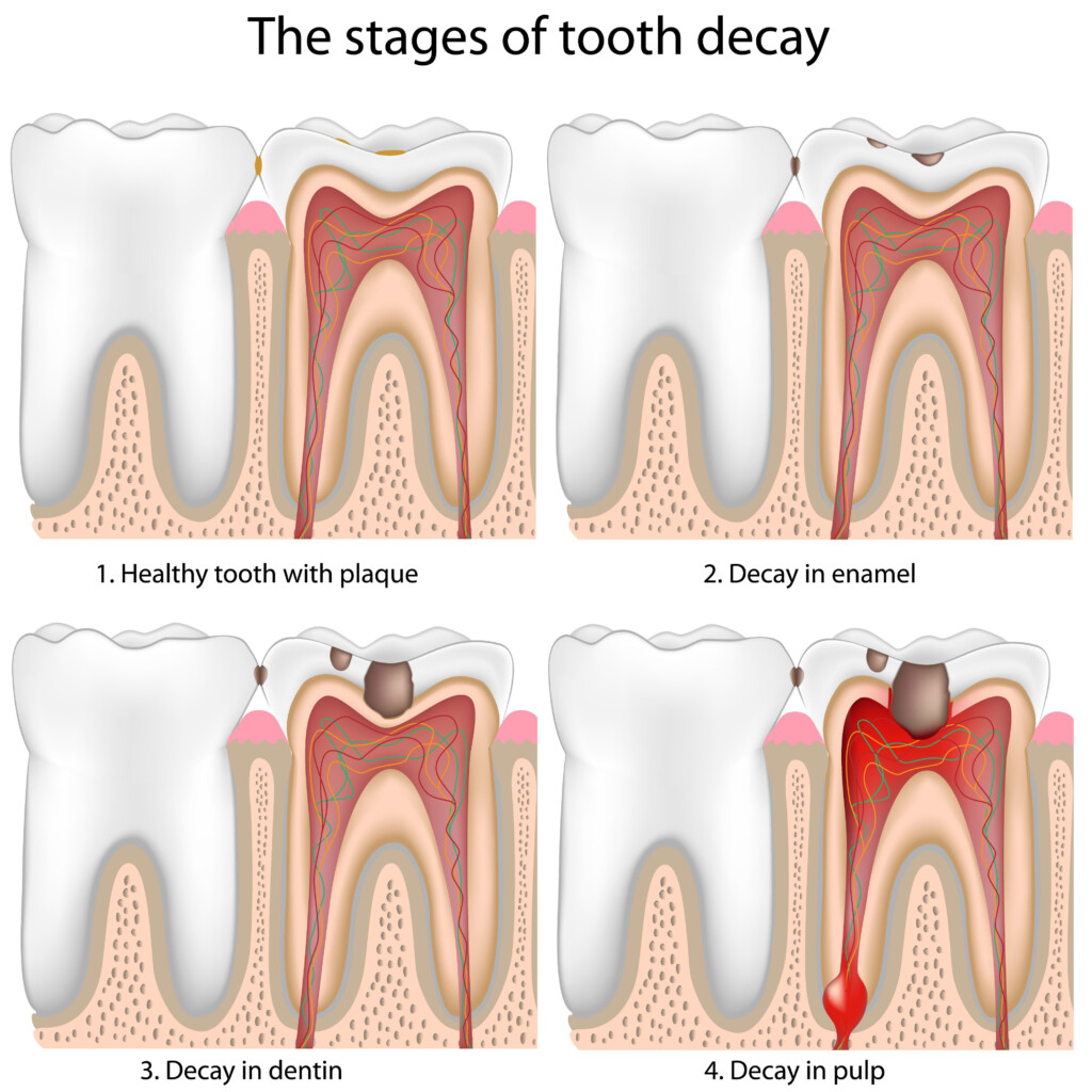 Stages Of Tooth Decay Houston TX - Chart Of Tooth Decay From Fast Food