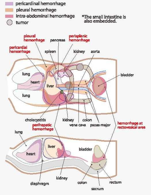 The FAST Exam Is Performed By Utilizing 4 Views Morrison s Pouch The  - Trauma Flow Chart Fast Exam