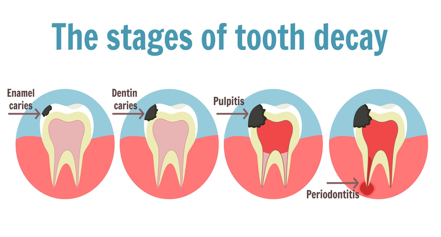 The Stages Of Tooth Decay Dentist Oakland Park FL - Chart Of Tooth Decay From Fast Food